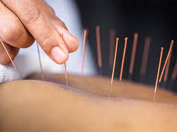 akupunktura poznań