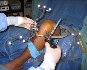 artroskopia kolana