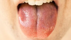 Zapalenie jamy ustnej - Przyczyny i leczenie