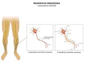 Neuropatia obwodowa - Polineuropatia - przyczyny, leczenie