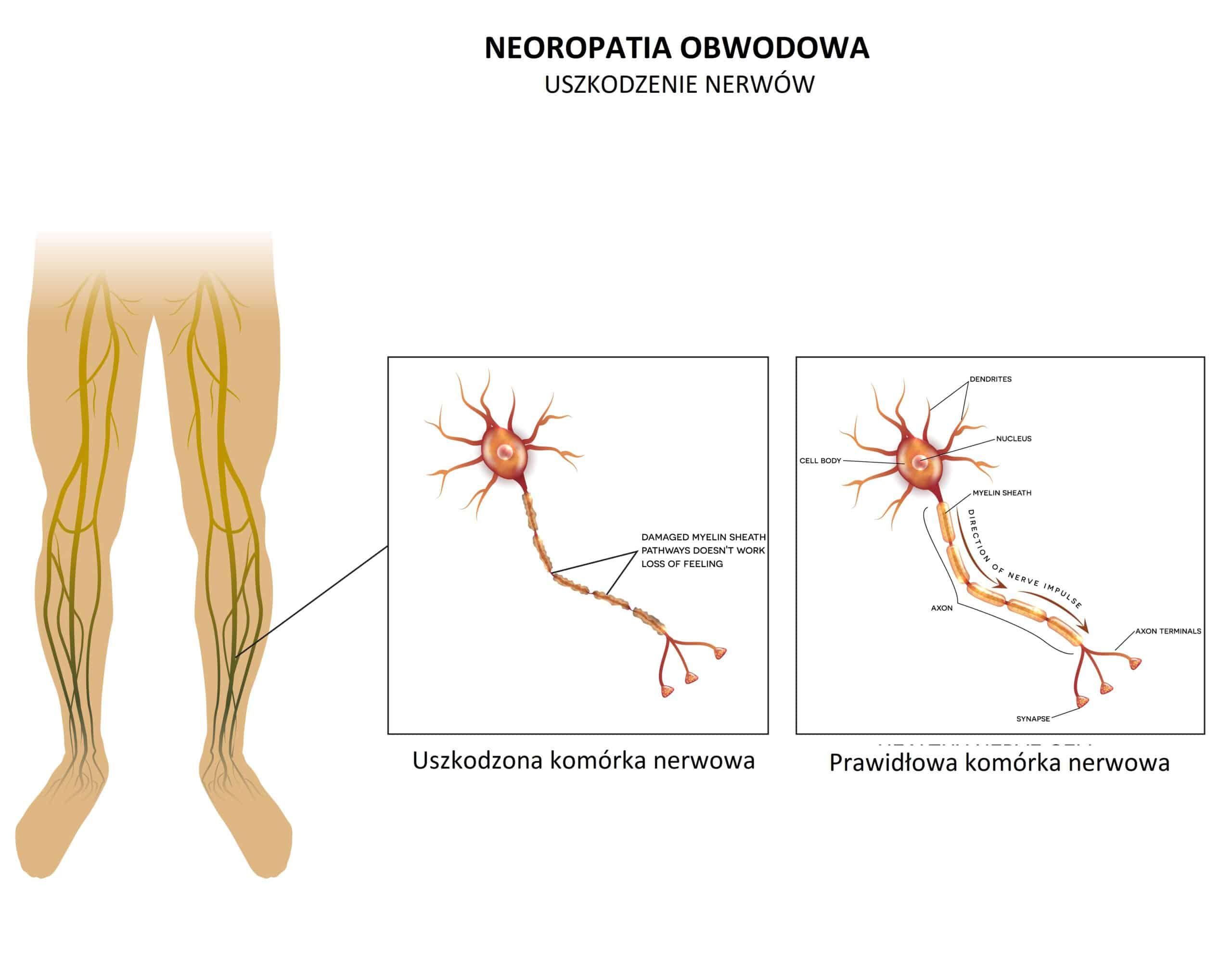 neuropatia obwodowa polineuropatia