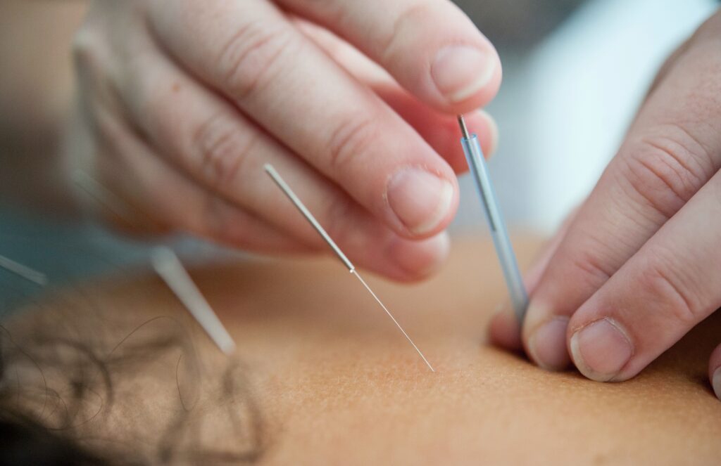 akupunktura na ból pleców w ciąży