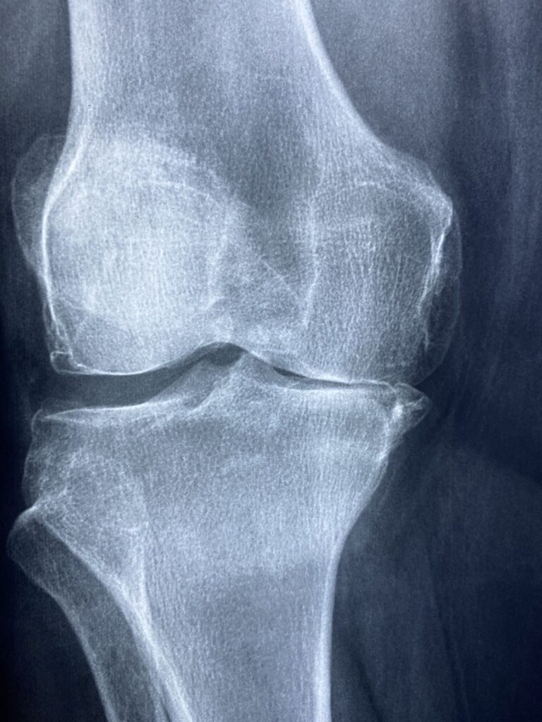 urazy powodujące ból pod kolanem