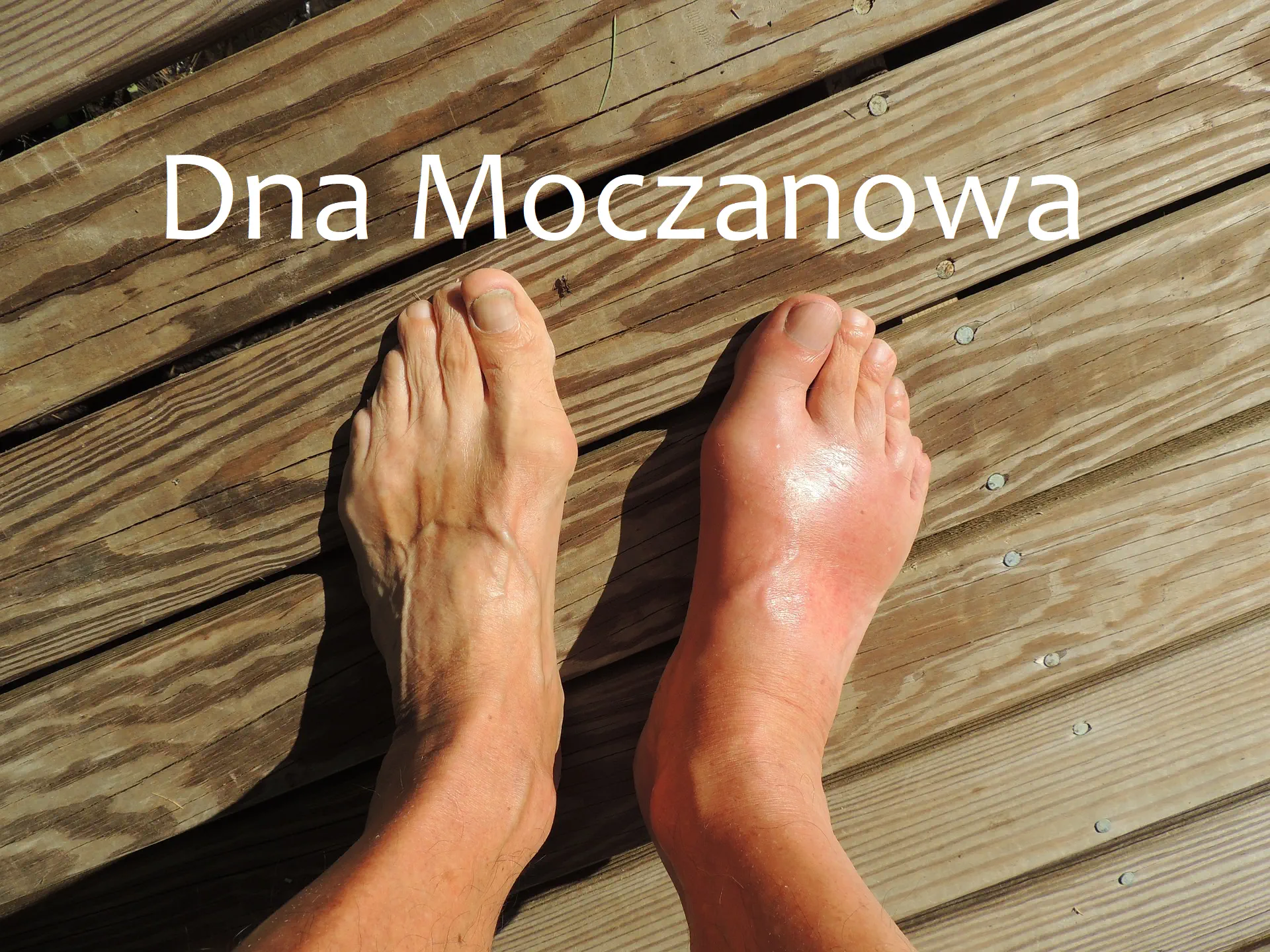 dna moczanowa